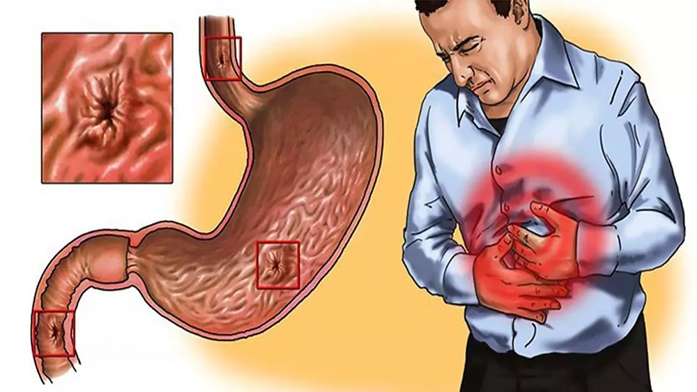 Što je gastritis i što uzrokuje njegov nastanak?